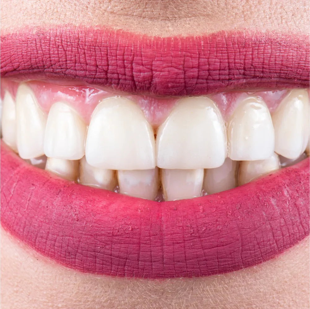 Before and after images of ruined teeth. These images show a result of the work of the dentist.