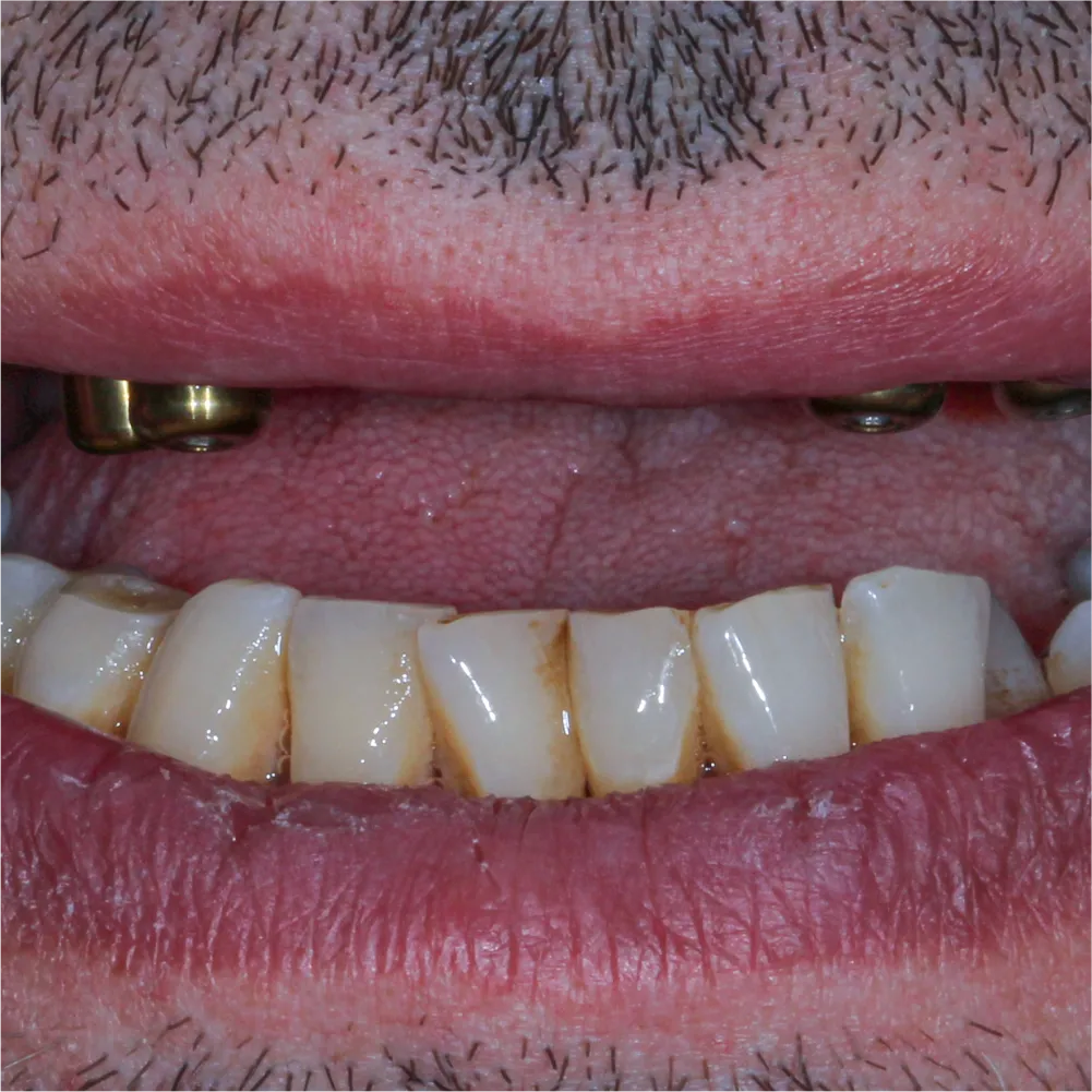 Before and after images of ruined teeth. These images show a result of the work of the dentist.