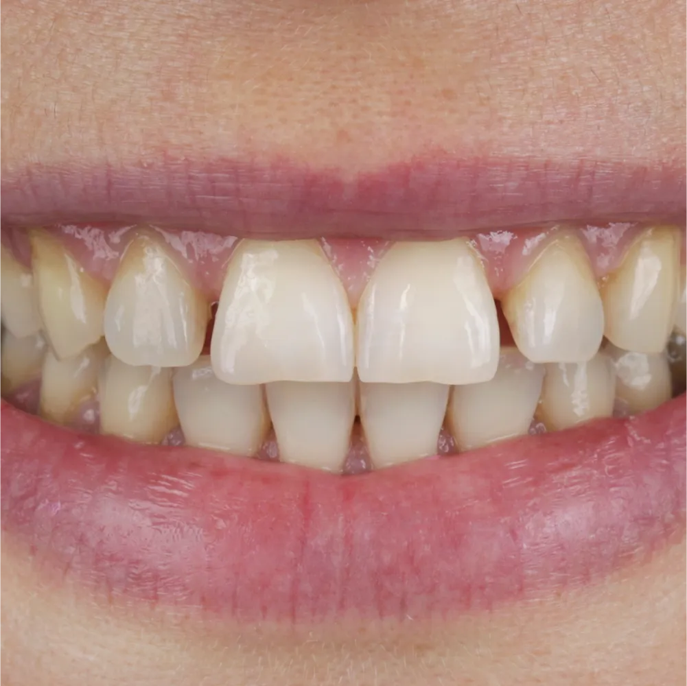 Before and after images of ruined teeth. These images show a result of the work of the dentist.