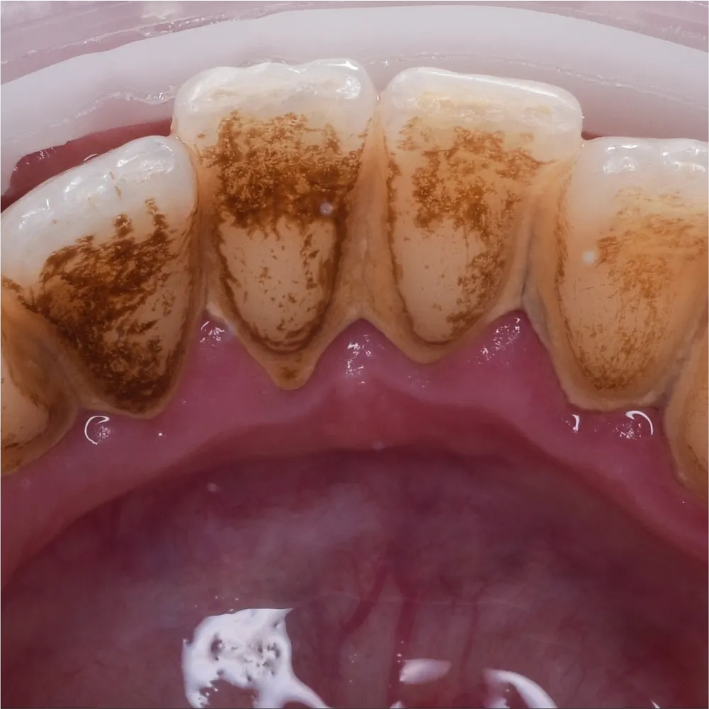 Before and after images of ruined teeth. These images show a result of the work of the dentist.