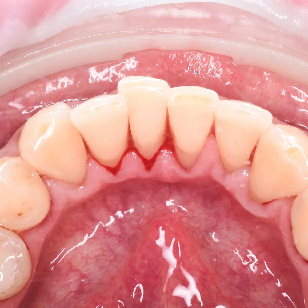 Before and after images of ruined teeth. These images show a result of the work of the dentist.