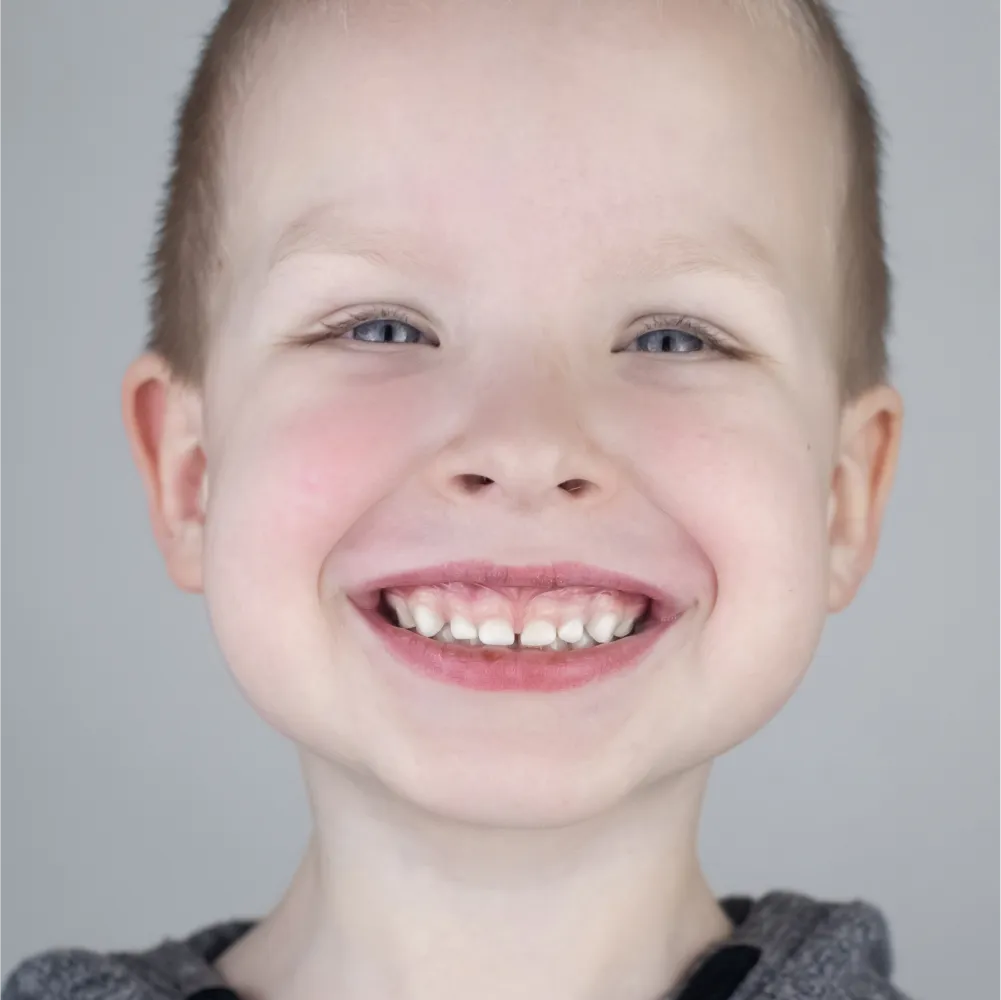 Before and after images of ruined teeth. These images show a result of the work of the dentist.