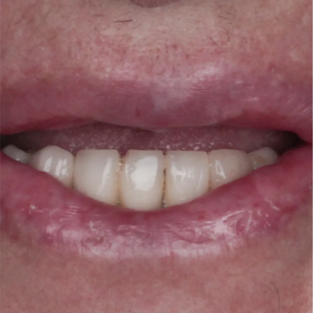 Before and after images of ruined teeth. These images show a result of the work of the dentist.