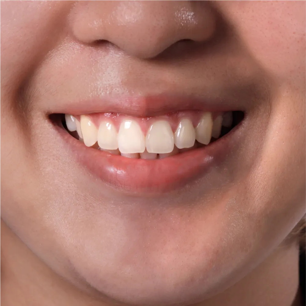 Before and after images of ruined teeth. These images show a result of the work of the dentist.