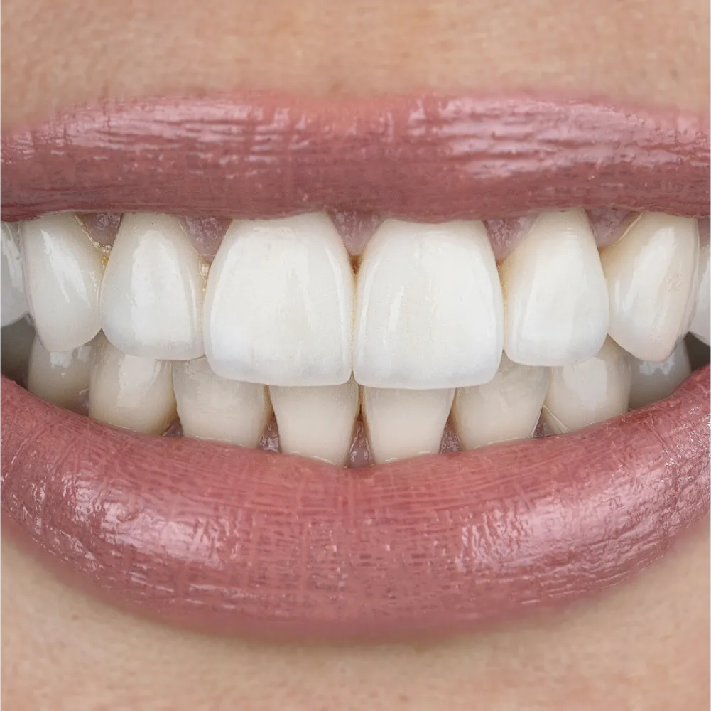 Before and after images of ruined teeth. These images show a result of the work of the dentist.