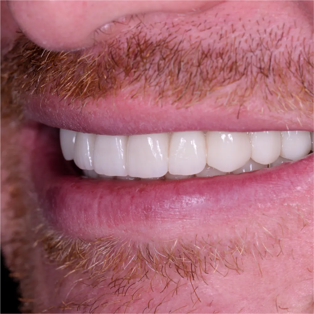 Before and after images of ruined teeth. These images show a result of the work of the dentist.