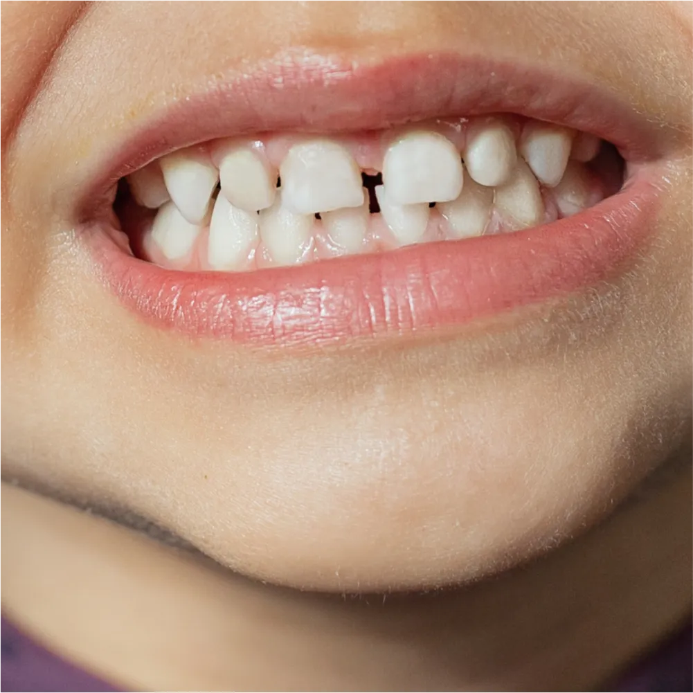 Before and after images of ruined teeth. These images show a result of the work of the dentist.