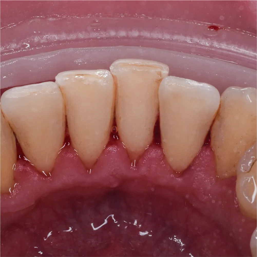 Before and after images of ruined teeth. These images show a result of the work of the dentist.