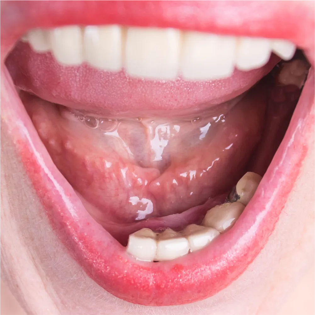 Before and after images of ruined teeth. These images show a result of the work of the dentist.