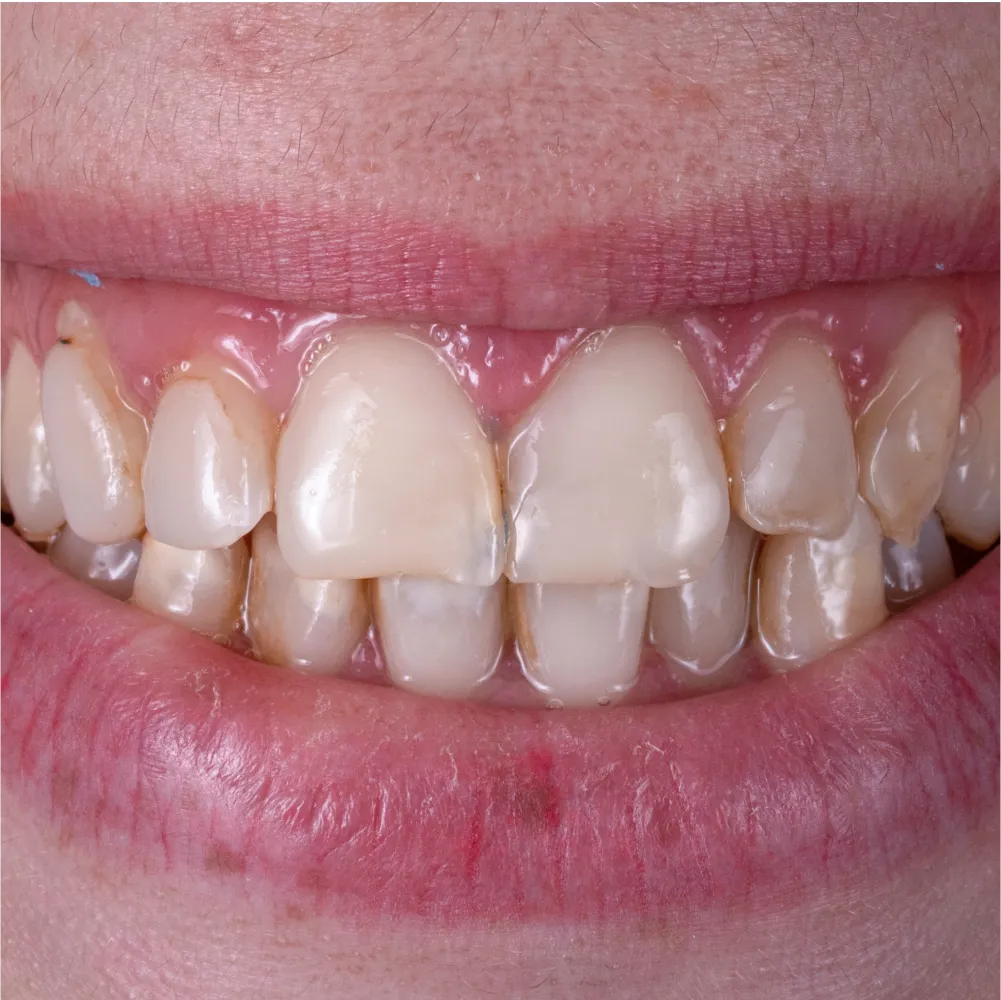 Before and after images of ruined teeth. These images show a result of the work of the dentist.