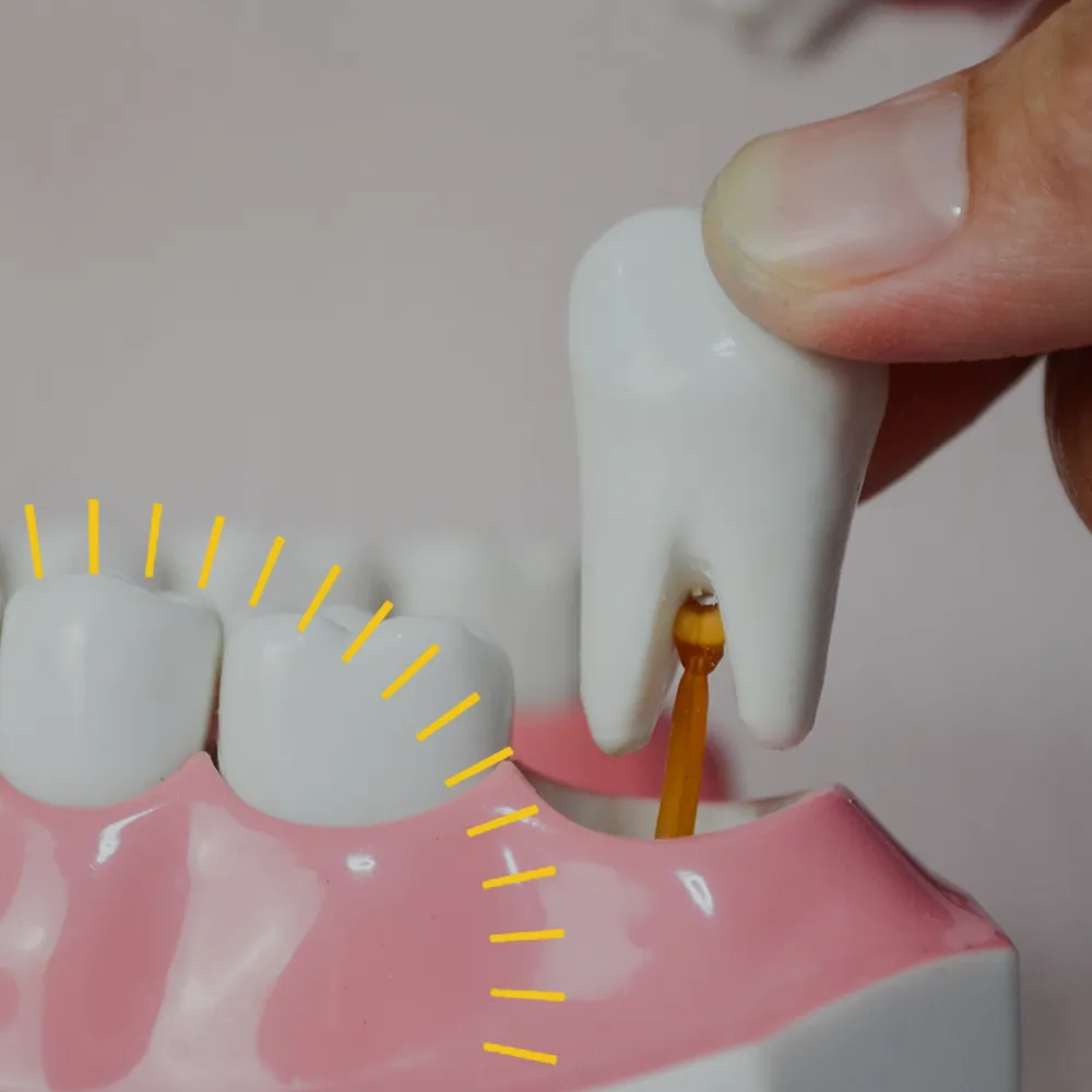 Tooth Extraction