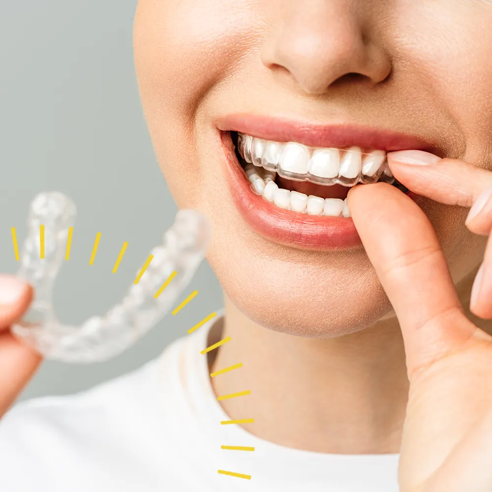 Invisalign Aligners