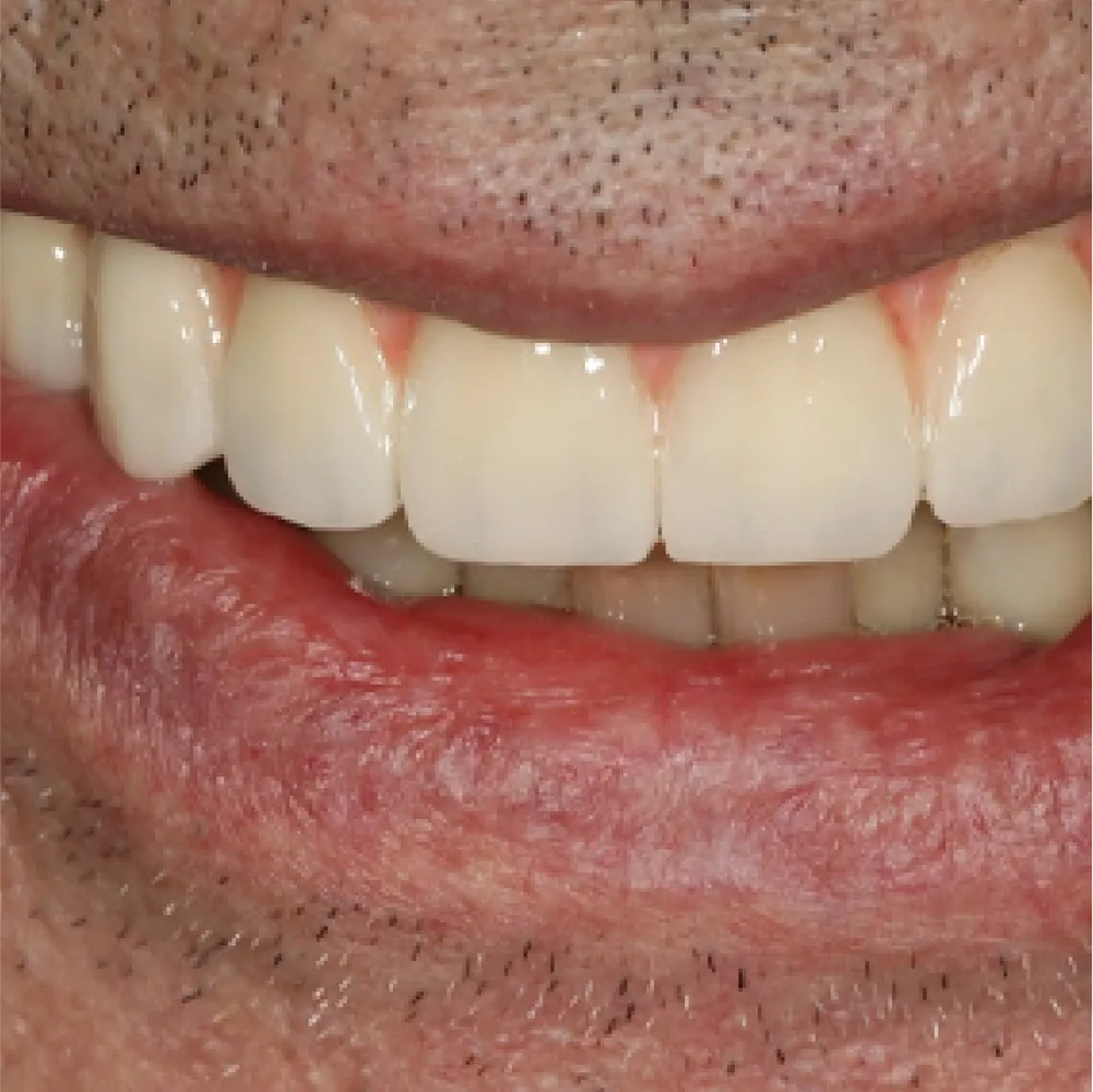 Before and after images of ruined teeth. These images show a result of the work of the dentist.