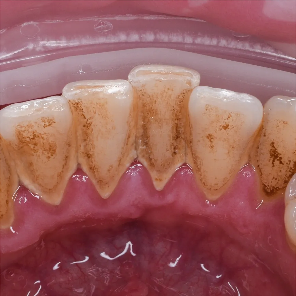 Before and after images of ruined teeth. These images show a result of the work of the dentist.