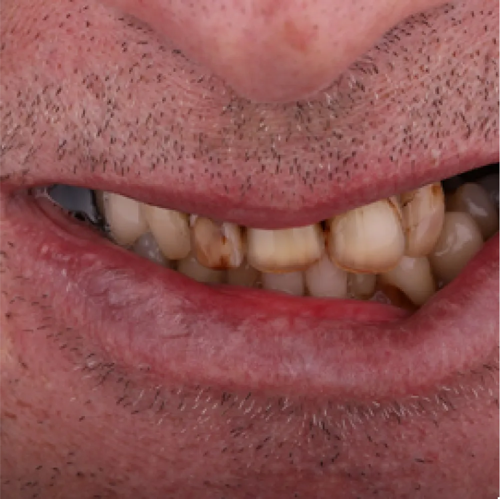 Before and after images of ruined teeth. These images show a result of the work of the dentist.